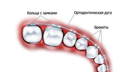Базовые элементы брекетов - Стоматология "Линия Улыбки"