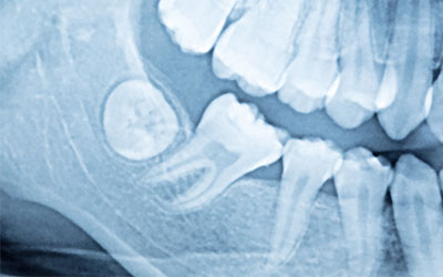 Боль может появиться из-за прорезывания «восьмерок» - Стоматология Линия Улыбки