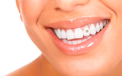 Скайс на зуб крепится при помощи специального адгезива - Стоматология Линия Улыбки