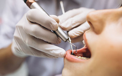 Удаление зуба при флюсе - Стоматология Линия Улыбки