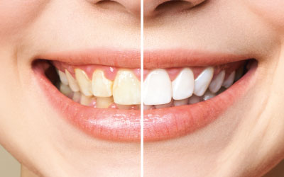Налет на зубах - Стоматология Линия Улыбки