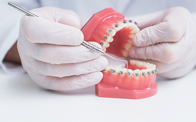 Брекет-системы и ортодонтические аппараты - Стоматология Линия Улыбки
