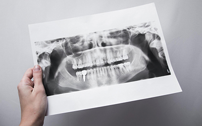 Организм стремится избавиться от зубного импланта - Стоматология Линия Улыбки