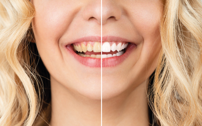 Отбеливание зубов - Стоматология Линия Улыбки