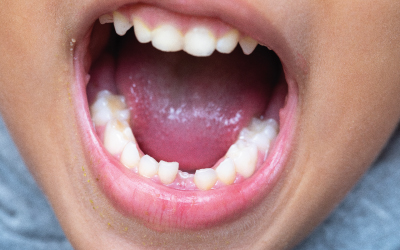 Потеря зуба - Стоматология Линия Улыбки