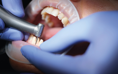 Пятна на зубах - Стоматология Линия Улыбки
