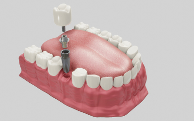 Зубные импланты - Стоматология Линия Улыбки