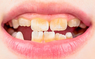 Симптоматика гипоплазии эмали зубов у детей - Стоматология Линия Улыбки