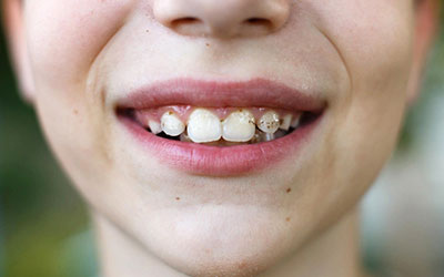 Зубной налет - Стоматология Линия Улыбки