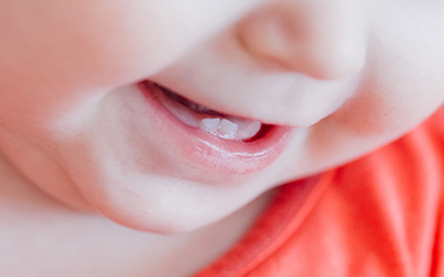 На поверхности зубов наблюдается желтовато-коричневое окрашивание - Стоматология Линия Улыбки
