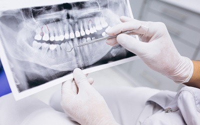Стекловолоконными штифтами укрепляют фрагменты зубов - Стоматология Линия Улыбки