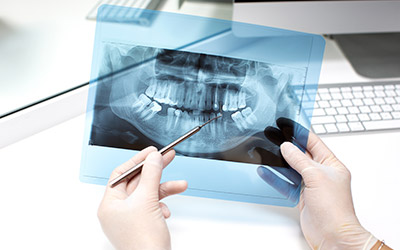 Корень зуба - Стоматология Линия Улыбки