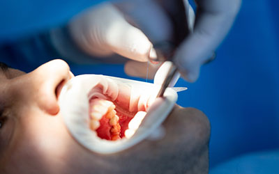 Композитная реставрация - Восстановление формы зуба 