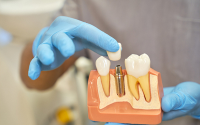 Потеря зуба - Стоматология «Линия Улыбки»
