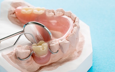 Бюгельные протезы для зубов - Стоматология Линия Улыбки