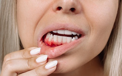 Спасаем зубную эмаль от воздействия лекарств | Стоматология Космодента