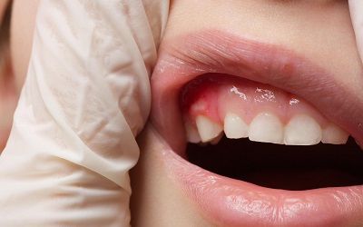 Дефект эмали зубов - Стоматология Линия Улыбки
