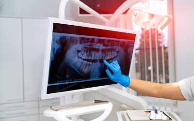 Этапы установки коронки на передний зуб - Стоматология Линия Улыбки
