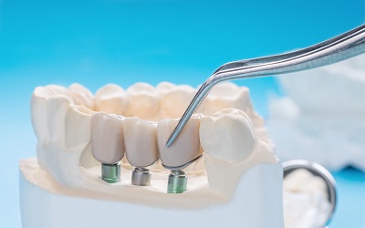 Этапы установки зубных протезов - Стоматология Линия Улыбки