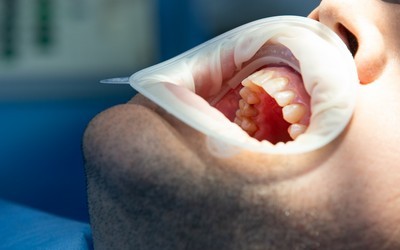 Факторы успешной имплантации - Стоматология «Линия Улыбки»