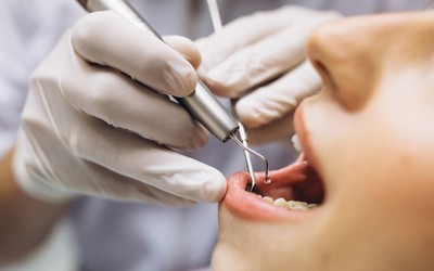 Имплант сразу после удаления зуба - Линия Улыбки