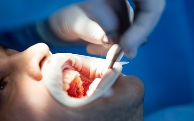implantaciya-strauman-stomatologiya-liniya-ulybki