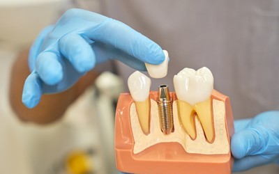Конструкция зубных импланты - Стоматология «Линия Улыбки»