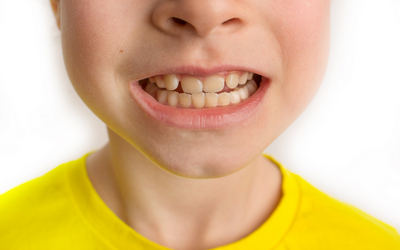 Коричневые молочные зубы - Стоматология «Линия Улыбки»