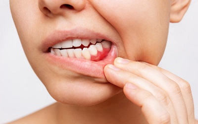 Снятие швов после имплантации зубов