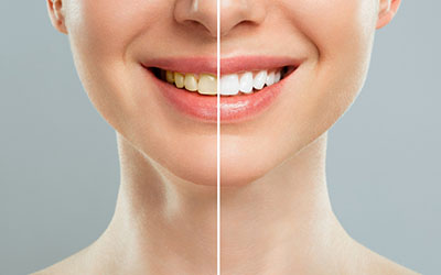 Диастемы зубов - Стоматология «Линия Улыбки»