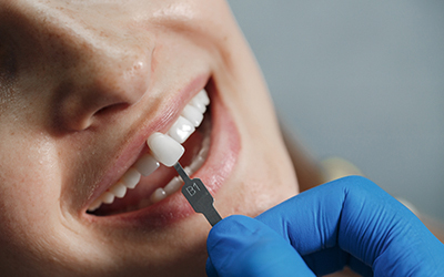 Наращивание зуба - Стоматология Линия Улыбки