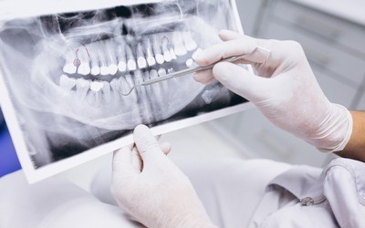 Низкая степень минерализации зубов - Стоматология Линия Улыбки