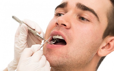 Основные этапы заживления лунки после удаления зуба мудрости - Стоматология Линия Улыбки