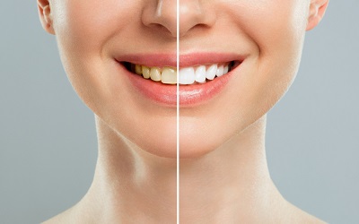 Осветление зубов на 2-4 тона - Стоматология Линия Улыбки