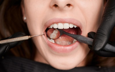 Последовательность удаления зуба ультразвуком - Стоматология Линия Улыбки