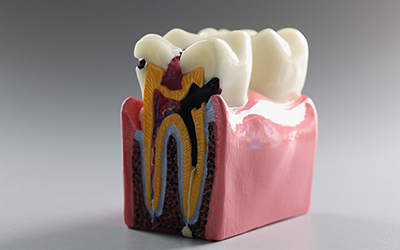 Разрушение корня зуба - Стоматология Линия Улыбки
