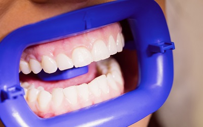 Удаление зубных осколков - Стоматология Линия Улыбки