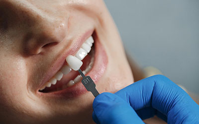 Подбор цвета эмали для коррекции зубов - Стоматология «Линия Улыбки»