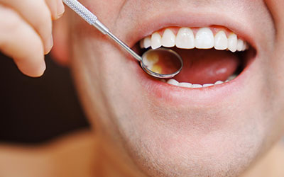 Наличие пломб в зубах - Стоматология «Линия Улыбки»