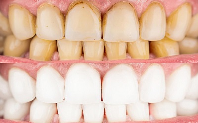 Восстановление любого разрушенного зуба - Стоматология Линия Улыбки