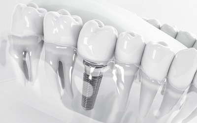 Зубные импланты - Стоматология Линия Улыбки