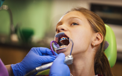 Высушивание зубной поверхности и покрытие ее клеем - Стоматология «Линия Улыбки»